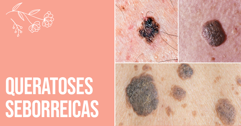três imagens de queratose